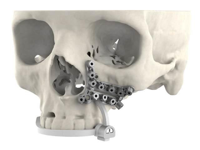 3D Systems Announces VSP® Hybrid Guides — Delivering Breakthrough Patient-specific, Occlusal-based Solution for Maxillofacial Surgeries